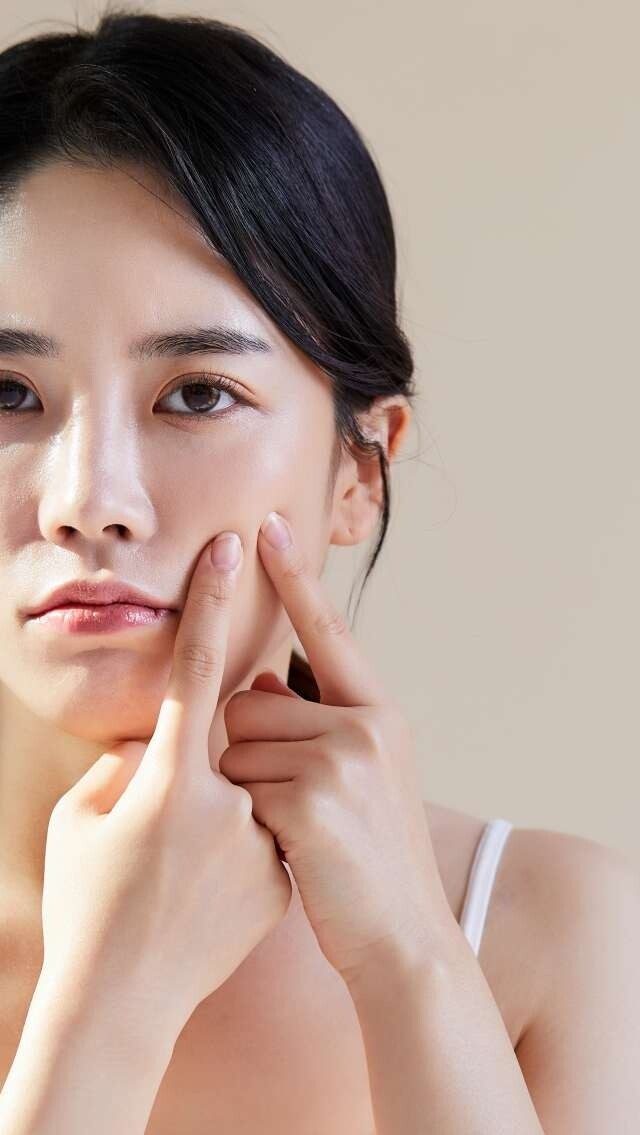 暗瘡急救！ 8個快速去暗瘡方法＋如何令暗瘡快速消失？