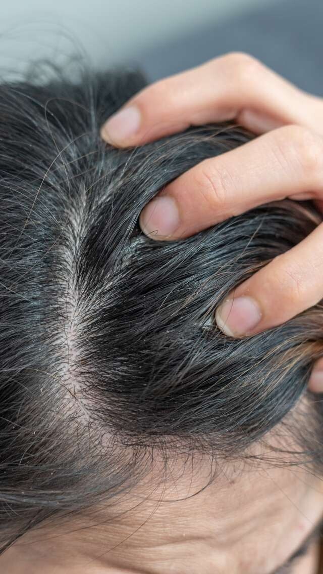 頭髮變幼有無得救？脫髮、毛囊萎縮甩頭髮頭髮變幼解決方法