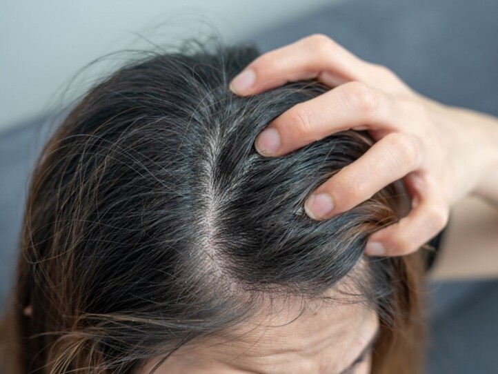 頭皮濕疹症狀認識與護理！如何判斷是不是濕疹？