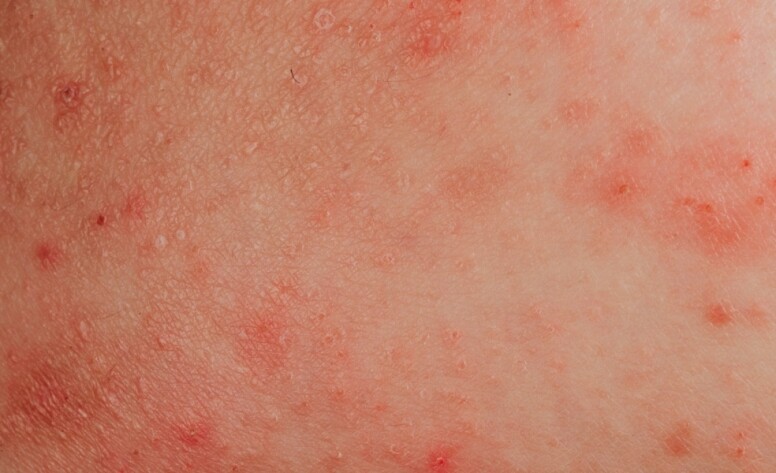 市面有不少濕疹cream或皮膚炎藥膏也標明可以纾緩濕疹，事實上這些濕疹