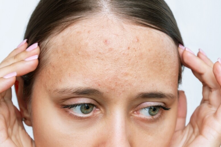 【額頭暗粒如何清除」 皮膚科醫生教你4個清除額頭油脂粒、去暗粒方法 + 暗粒成因！