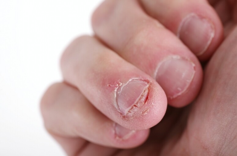 手指脫皮乾燥! 手指龜裂指緣粗糙點算？8大手指脫皮成因預防倒刺貼士