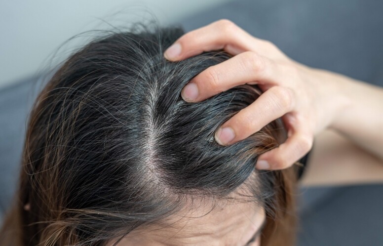 頭皮濕疹症狀認識與護理！如何判斷是不是濕疹？