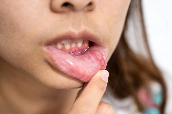 飛滋膏推介｜5款痱滋藥推薦！附痱滋膏消委會成分說明、痱滋成因！