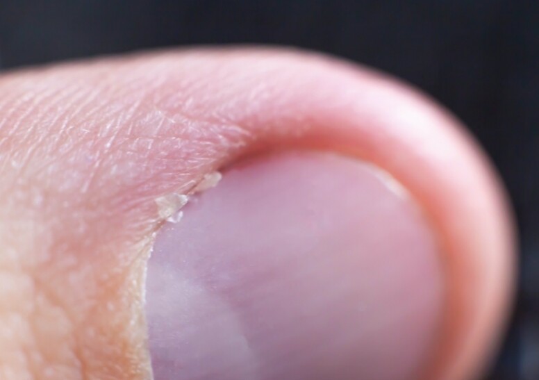 手指脫皮乾燥! 手指龜裂指緣粗糙點算？8大手指脫皮成因預防倒刺貼士