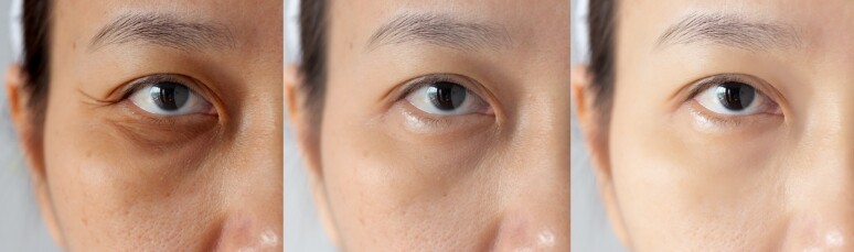 黑眼圈很重！中醫推薦3大黑眼圈消除方法告別熊貓眼